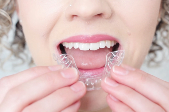 Invisalign orthodontics